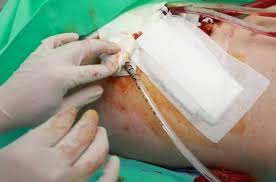 Again, considering a graze wound is mostly a skin injury then applying pressure should be enough to stop the bleeding. Types Of Wound Drainage Identifying Features