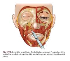 Image result for Ear Nerve Block