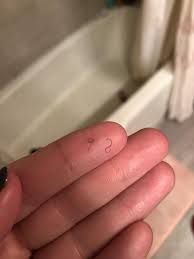 The commonest complication is infection, as this region is exposed to many germs. Gnarly Ingrown Hair From My Pubic Area Popping