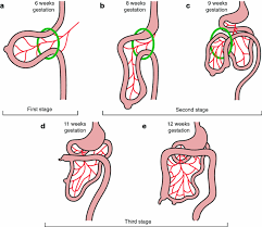 Image result for Intestinal Malrotation