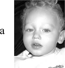 The MCT8 thyroid hormone transporter and Allan-Herndon-Dudley syndrome.