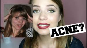 Deze huismiddeltjes kunnen je makkelijk en simpel van je puistjes af helpen. Hoe Ik Van Acne Afkwam Ervaring Met De Pil Kristina K Youtube