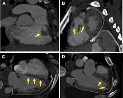 Accumulations and deposits the pathology guy. Intracardiac Involvement By Primary Malignant Mesothelioma A Report Of Two Cases Journal Of Thoracic Oncology