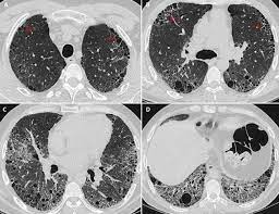 Uip Pattern Interstitial Lung Disease In Rheumatoid Arthritis Radiology Case Radiopaedia Org