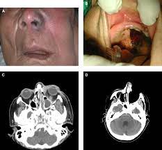 Fungal Disease Of The Nose And Paranasal Sinuses Journal Of Allergy And Clinical Immunology