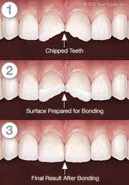 When you say tooth is broken, the are different ways it can be broken. How To Fix A Chipped Tooth With A Cosmetic Dentist