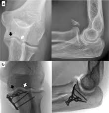 Image result for Coronoid Process Fracture