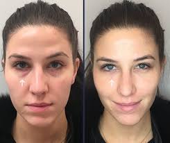 Find out more about dermal fillers in united kingdom. Under Eye Fillers For Dark Circles Efficacy Photos Cost Side Effects Under Eye Fillers Dark Eye Circles Dark Under Eye