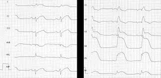 Myocarditis (mk) is a cardiovascular disease characterized by heart muscle damage due to the development of inflammation in the tissues of the the most frequent ecg signs of myocarditis Ekg Bei Myokarditis Fokus Ekg