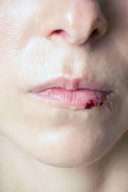 Split lip: Causes, treatments, and home remedies