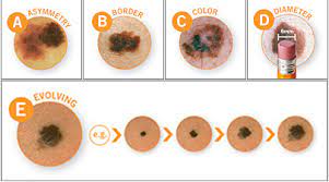 06.11.2017 · types of biopsies for skin cancer and what to expect shave biopsy. Skin Cancer Understanding Your Biopsy Patient Specials Charleston Sc Germain Dermatology
