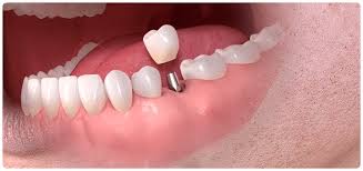 Dental Implants in Turkey | New Teeth Turkey | Dentist In Turkey