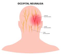 Occipital Neuralgia | Aurora Health Care