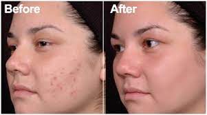 They are prescribed to women in combination with combined oral contraceptives (coc). Ipl Acne Treatment Lose It With Laser