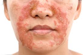 Image result for Atopic Dermatitis