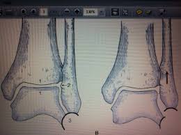 The objective of the current study was to review the published clinical evidence available for the treatment of maisonneuve fractures. Ankle Fractures Trauma Orthobullets