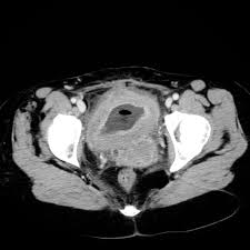 Wide of the fallopian tube, resulting in menstrual blood without obstruction. Endometriosis Of The Bladder Ct Radiology Case Radiopaedia Org