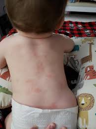 Image result for sweat rash on back baby