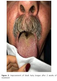 Image result for black hairy tongue symptoms