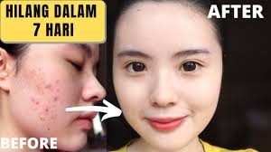 Bahan alami lain untuk menghilangkan bekas jerawat yaitu, menggunakan kunyit. Cara Paling Cepat Menghilangkan Bekas Jerawat Dalam 7 Hari Youtube