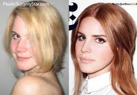 Rhinoplasty, commonly referred to as a nose job, is a surgical procedure that is used to alter the length, shape, contour of the nose, modify the nostrils, or lift and define the tip of the nose. Lana Del Rey Plastic Surgery Plastic Surgery Nose Job Injectables Fillers