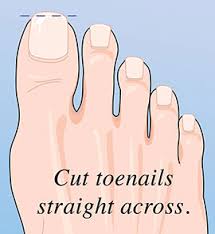 The ingrown toenail is one of the most common toe problems i treat. Ingrown Toenails