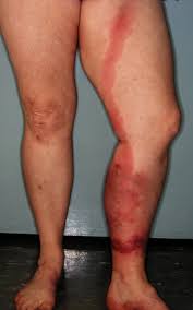 Image result for Cellulitis