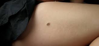 Wie heißen die bräunlichen muttermale, aus den dunkle haare hinauswachsen? Leberfleck Ursachen Beschwerden Diagnose Behandlung Prognose Vorbeugung Gesundmed Medizin Und Gesundheit Im Web