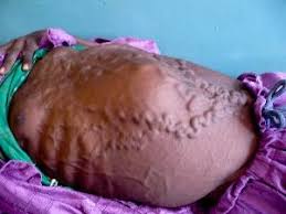 End Stage Liver Disease Liver Disease Liver Health Liver