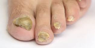 Image result for mykoza nehtů