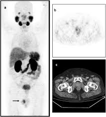 29.03.2016 · another risk factor is race. Isolated Testicular Metastasis From Prostate Cancer Detected On Ga 68 Psma Pet Ct Scan Springerlink