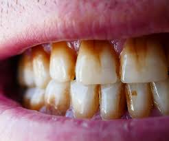 Image result for Tooth Discoloration