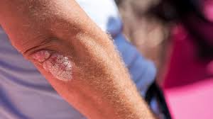 Image result for psoriasis