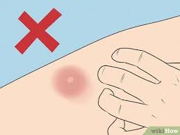 Do you recall those litmus tests from school? 11 Ways To Get Rid Of A Mosquito Bite Wikihow