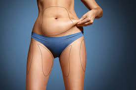 Liposuctie Surgiplast Hasselt