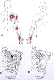 Pin On Triggers Points Therapy Xi