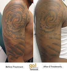 Super Pleased With The Progress On This Half Sleeve After Just 2 Laser Tattoo Removal Treatments The Client W Laser Tattoo Laser Tattoo Removal Sleeve Tattoos