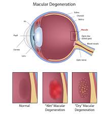 Mamaroneck Macular Degeneration Treatment Amd Treatment In