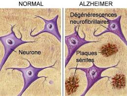 Dans la grande famille des la forme sporadique de la maladie n'est pas héréditaire et peut frapper n'importe qui au sein de la population. Causes Et Facteurs De Risque De La Maladie D Alzheimer