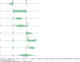 Approach To The Patient With A Heart Murmur Harrisons