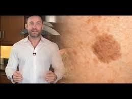 как быстро избавиться от пятен после прыщей на лице Ot Pigmentnyh Pyaten Pomozhet Izbavitsya Prostoj Tryuk X2f Kak Izbavitsya Ot Pigmentnyh Pyaten Youtube Lico Temnye Pyatna Na Kozhe Temnye Pyatna