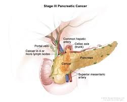Pancreatic cancer most pancreatic cancers are exocrine cancers. Pancreatic Cancer Treatment Adult Pdq Treatment Patient Information Nci Cs Mott Children S Hospital Michigan Medicine