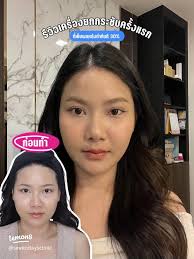 เครื่องยกกระชับ Thermalift: ความงามที่เห็นผลทันที