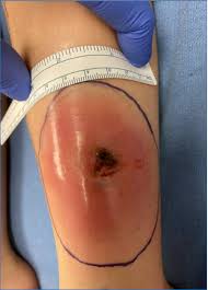 Image result for Pyoderma Gangrenosum