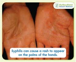 Image result for syphilis symptoms