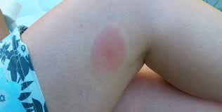 Image result for mosquito bite