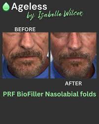 Looking for a natural alternative to traditional fillers? Discover PRF  BioFiller — the power of your own body to restore youthful volume! • Up to  4x more filler than traditional injectables •