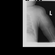 Osteopenia Of Prematurity In An Extremely Low Birth Weight Infant