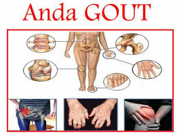 Jika anda sering mengalami sakit sendi, apakah anda mempunyai risiko mendapat gout? Vivix Dan Gout Kisah Seorang Ayah Menderita Gout Kini Semakin Pulih Mamahana88
