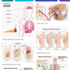 Patients may register at any time from the time of diagnosis of stage iv breast cancer (if eligibility criteria met) to the time when a maximum of. Townsville And Surroundings Stage 4 Breast Cancer Mums Home Facebook